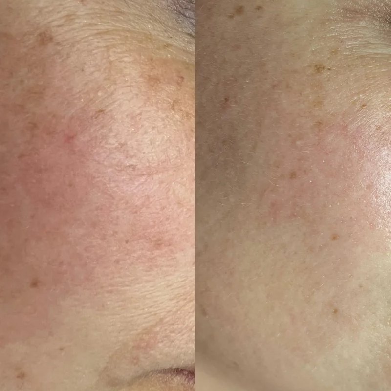Pigment en ongelijke kleur op de wang, voor en na